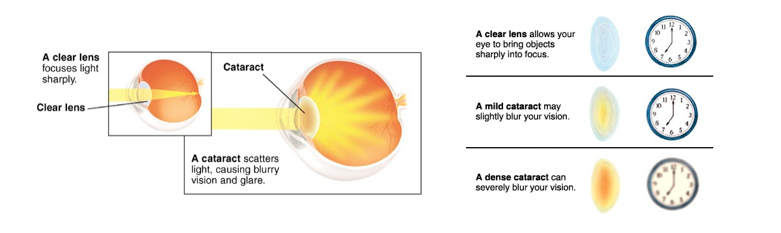 diagram-of-cataracts