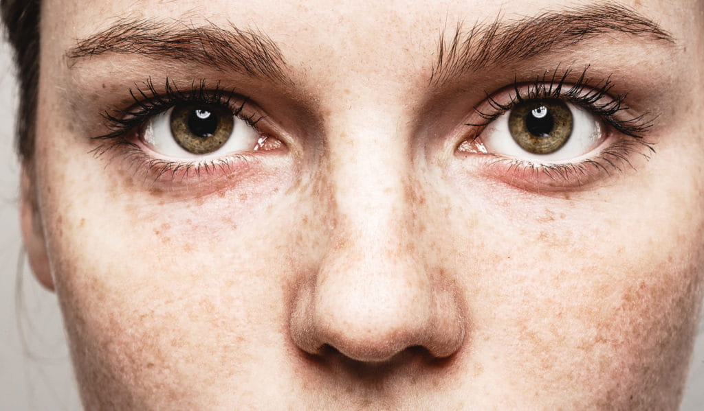 Women's eyes after LASIK eye surgery in Iowa.