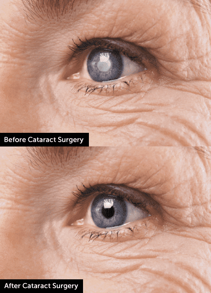 before-after-cataract-surgery