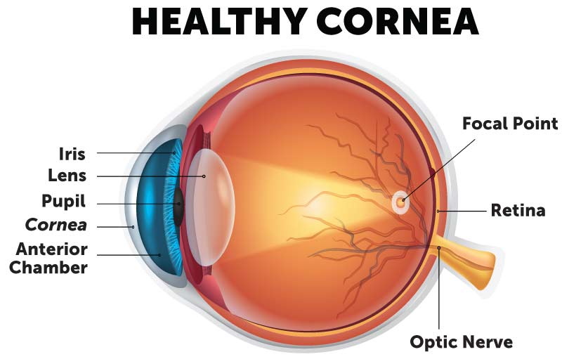 Cornea diagram of an eye with a healthy cornea and light refraction.