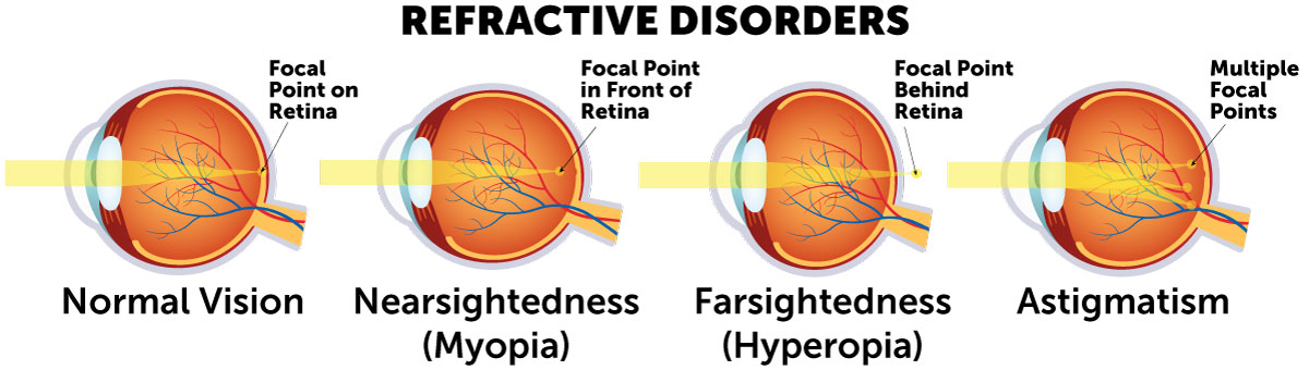 Refractive disorder diagram comparing cornea curvature and light refraction in myopia, hyperopia and astigmatism.