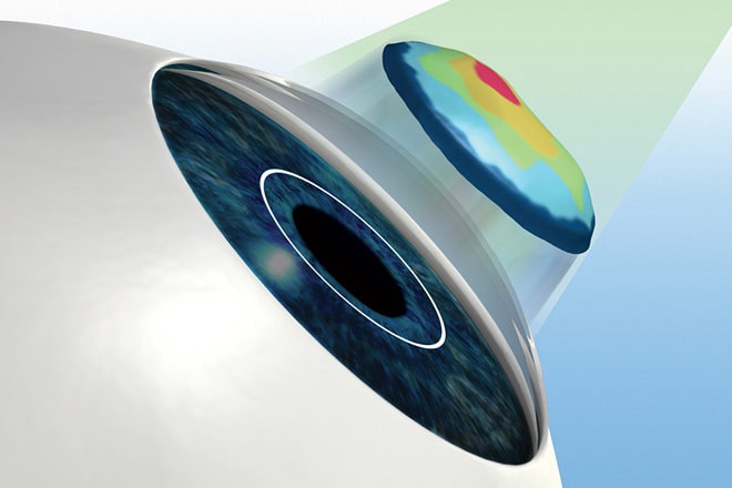 Cornea topography test illustrating cornea curvature for LASIK laser eye surgery.
