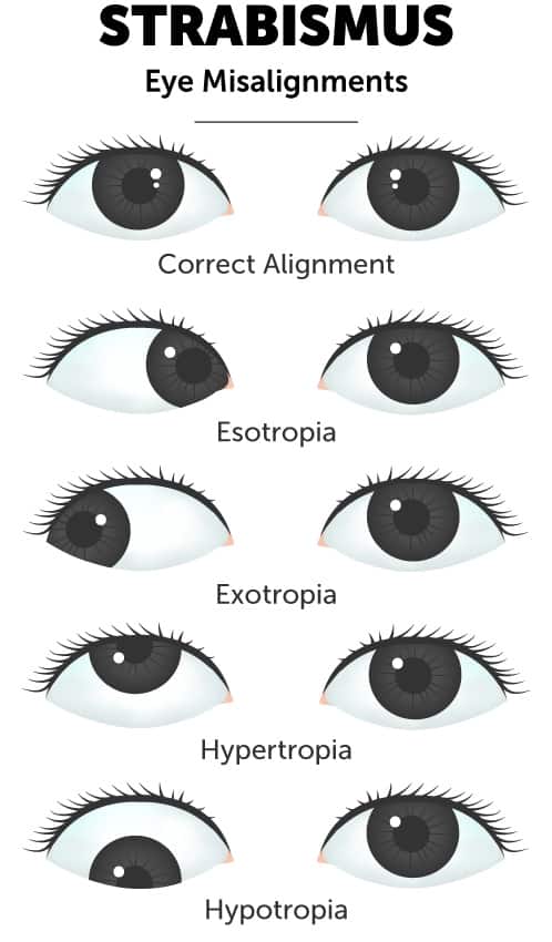 Strabismus eye misalignment diagram illustrating the different ways eyes can drift due to strabismus in comparison to healthy eye alignment.