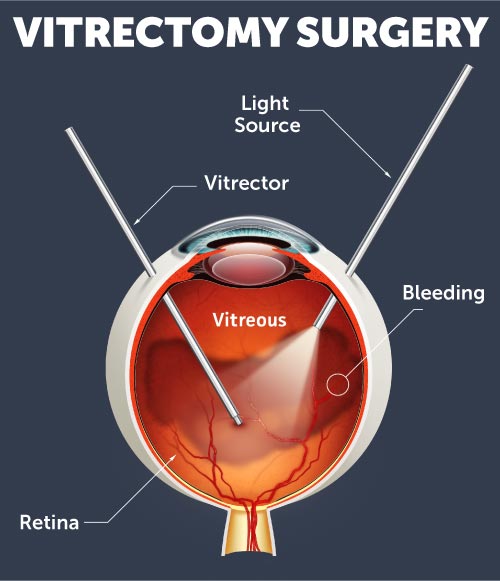 Retina surgery diagram illustrating vitrectomy surgery for retina conditions in Iowa at Wolfe Eye Clinic.