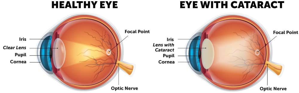Cataract diagram: Cataract vision symptoms manifest when light is diffused through a cataractous lens.