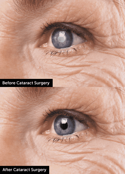 Vision After Cataract Surgery, Elmquist Eye Group