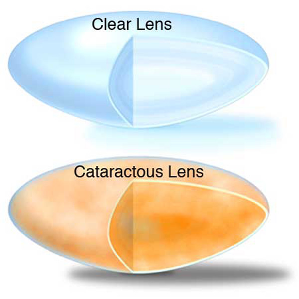 Cataract diagram of clear eye lens without a cataract and a cataractous lens.