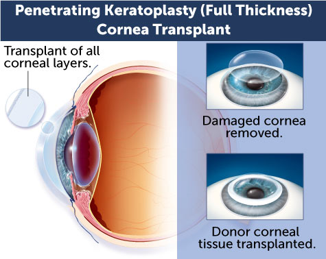 Corneal transplant diagram of PK full thickness cornea transplant at Wolfe Eye Clinic.