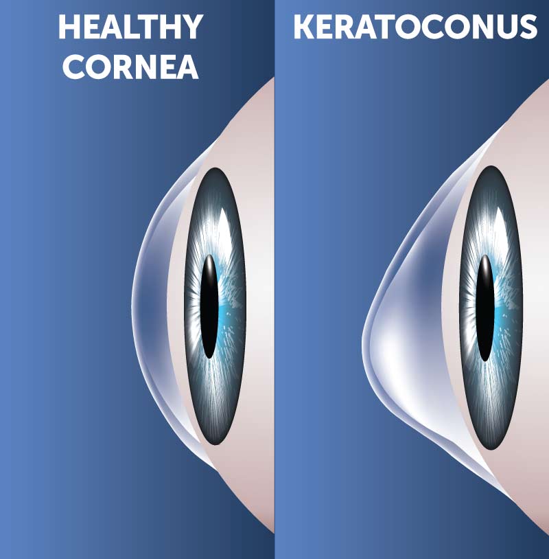 Keratoconus diagram comparing the shape of a healthy cornea and a bulging cornea with keratoconus.