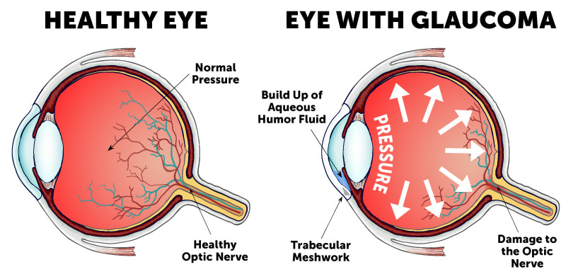 Glaucoma Symptoms | Ames Glaucoma Doctor
