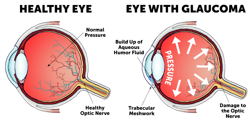 Glaucoma Eye Diagram Eye with glaucoma symptoms