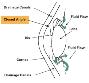 Closed-angle glaucoma diagram illustrating the restricted flow of fluid within an eye that has narrow angle glaucoma.