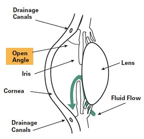 Open-angle glaucoma diagram showing the flow of eye fluid within an eye that has open-angle glaucoma.