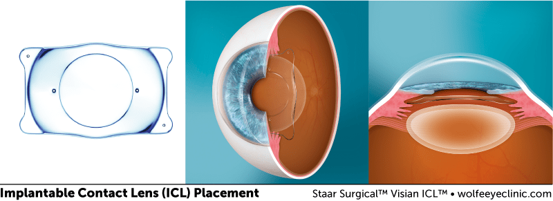 icl-placement-diagram