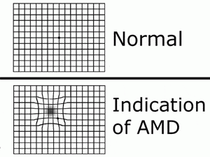 What patient with macular degeneration (AMD) sees on Amsler grid, an at-home vision test available at Wolfe Eye Clinic.