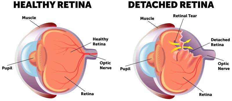 Can You Prevent and Treat Retinal Detachment?