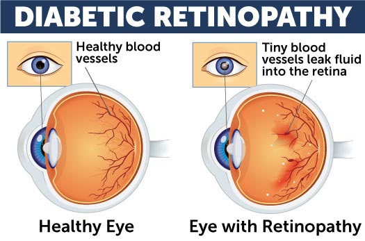 Diagram of diabetic eye disease comparing a healthy retina to a retina with diabetic retinopathy. 