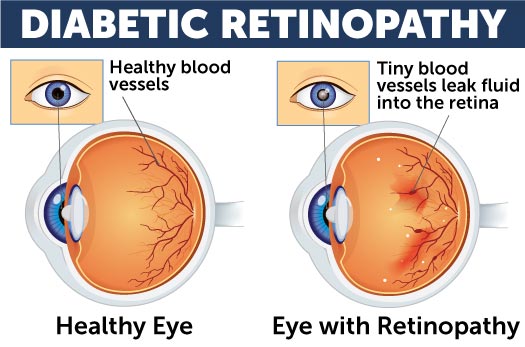 Diabetic retinopathy diabetic eye disease