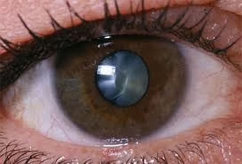 Eye with cataract.