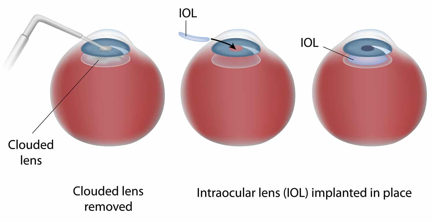 Chart illustrating the laser cataract surgery process