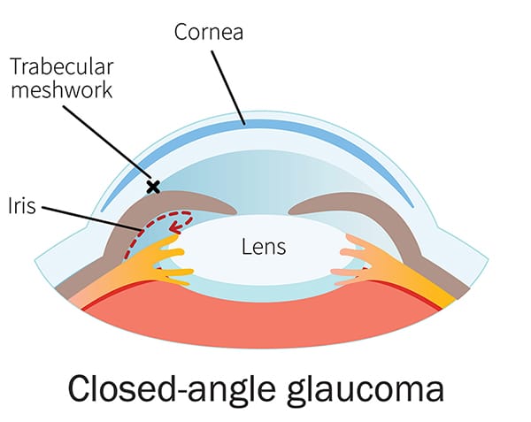Chart showing how closed-angle glaucoma affects an eye