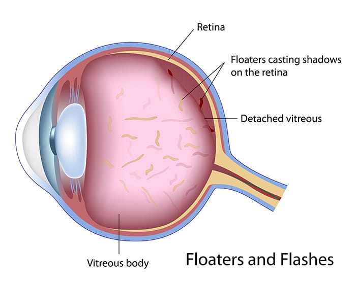 Chart illustrating floaters in an eye