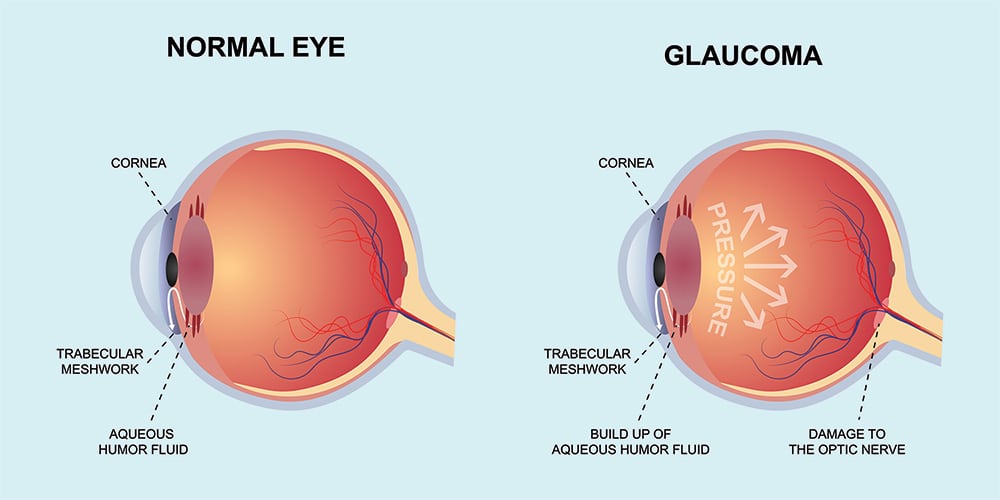 Chart showing a normal eye compared to one with glaucoma - increased pressure in the eye