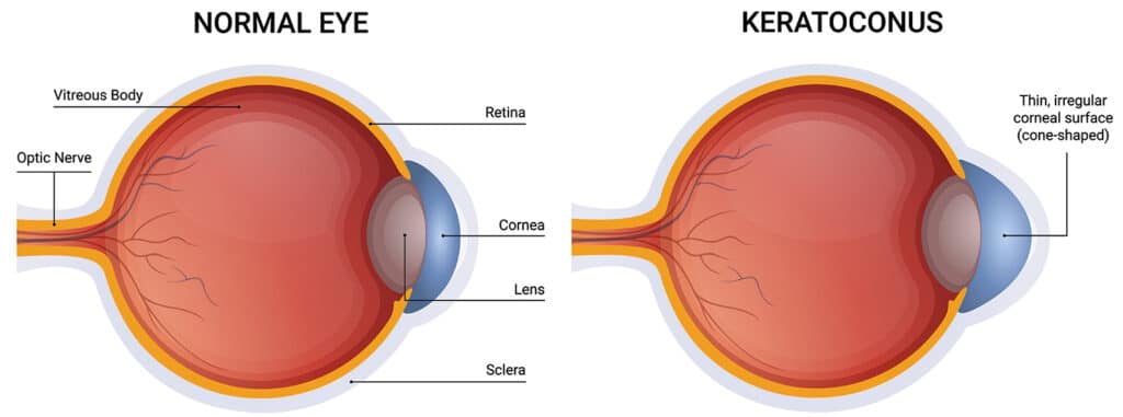 chart illustrating a normal eye compared to one with keratoconus (thin, irregular corneal surface cornea)