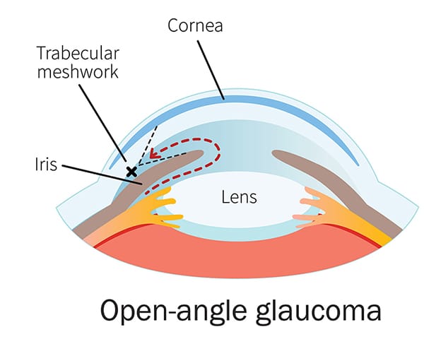 Chart showing how open-angle glaucoma affects an eye